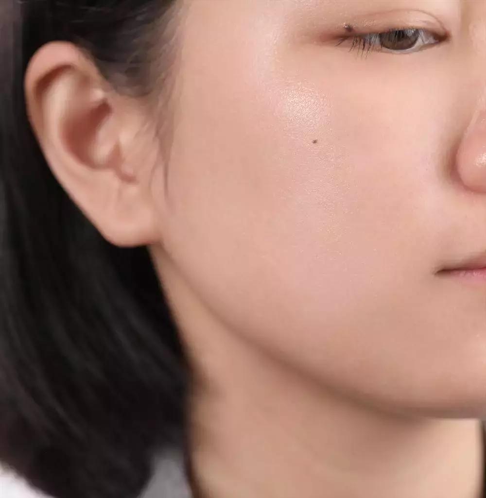 战痘技巧｜林允儿和小甜甜的痘痘可不是一回事