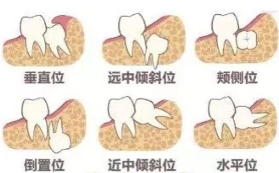 孕期牙疼千万不要忍着,孕期牙疼千万别硬抗