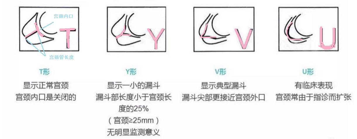 宫颈机能不全是不是容易痛,宫颈机能不全好治吗