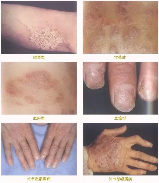 荨麻疹脸上留下的红色印记,长春二院怎么治荨麻疹