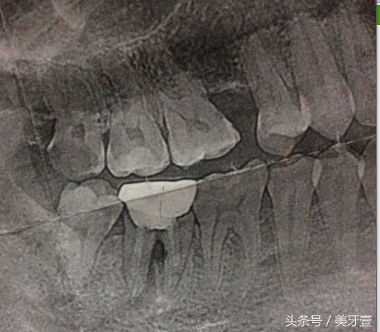 牙齿骨折有什么特征,牙齿骨折怎么修复