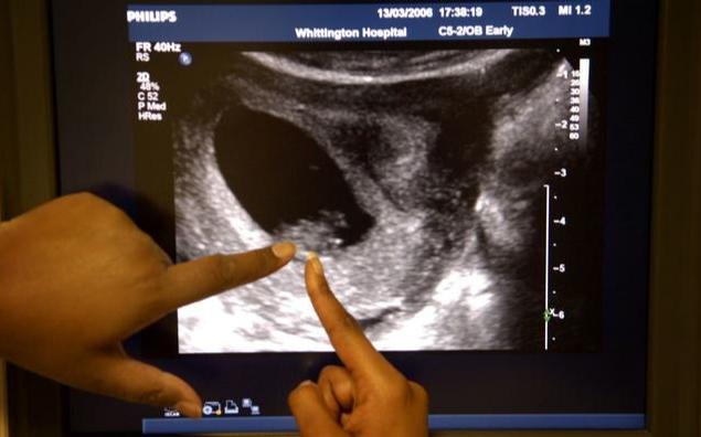 怀孕初期出血肚子疼孩子能保住吗,怀孕初期出血孩子还能不能保住