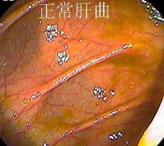 正常肠镜报告单图片大全,正常肠道的肠镜图片