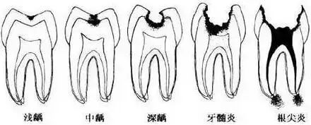 蛀牙三颗算多吗,蛀牙是怎么吃掉牙齿的