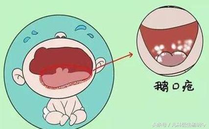 小儿鹅口疮鉴别,小儿鹅口疮症状病因及治疗