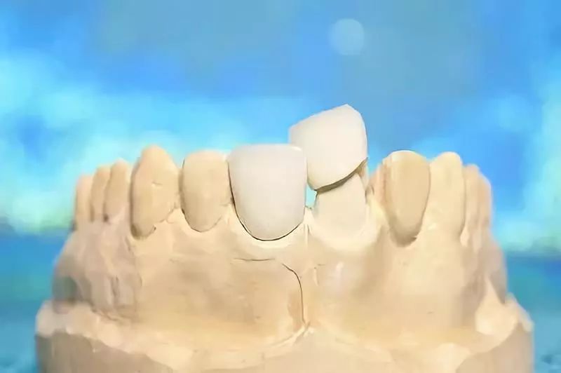 烤瓷牙与全瓷牙价格对比,烤瓷牙和全瓷牙价格差多少钱一颗