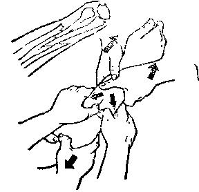 中医骨折治疗原则,中医骨伤整复术