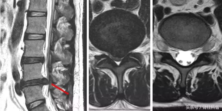 腰腿疼的防治误区,腰腿侧边疼怎么自测