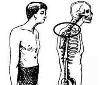 正骨疗法可以治疗富贵包吗,富贵包正骨针灸治疗视频