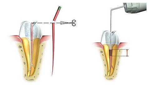 牙齿劈裂到什么程度就需要拔掉了,牙齿劈裂可以长好吗