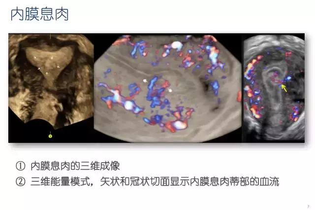 妇科超声波探头,福建省妇幼保健院输卵管超声造影