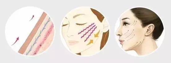 反复线雕面部的优点和缺点,面部线雕失败图片