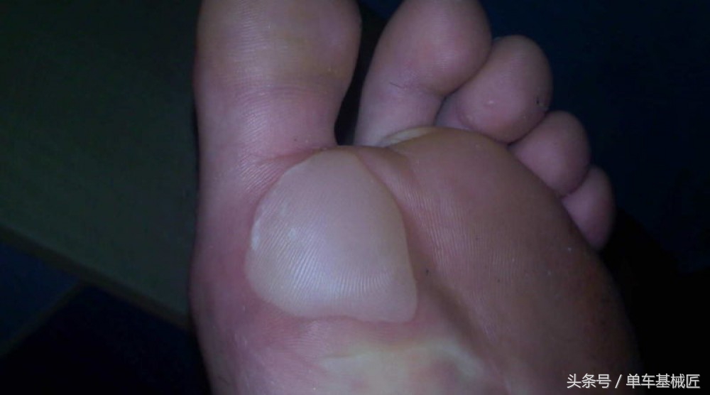 骑自行车磨出了水泡多久自愈,骑行脚上会磨出水泡吗