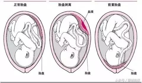 女子33岁怀孕后续,35岁的女子怀孕31周竟是三胞胎