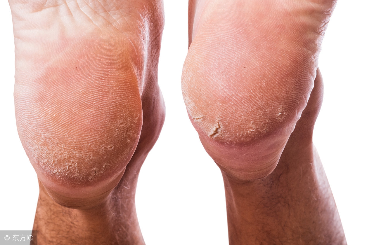 脚后跟鱼鳞状干裂怎么治疗,脚后跟像鱼鳞一样一层层干裂中医