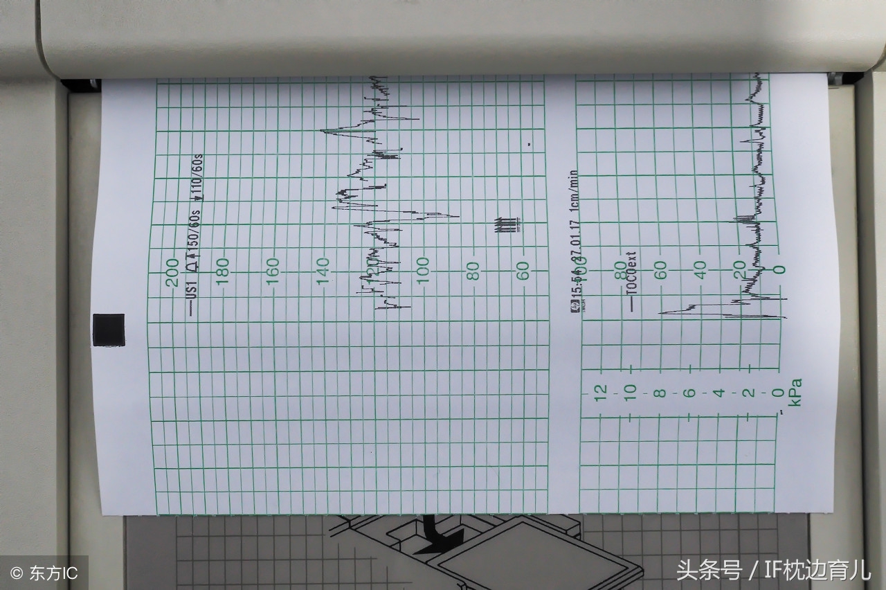 胎心监护曲线波动比较大,胎心监护上什么代表有宫缩