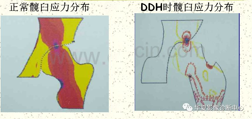 先天性髋关节脱位截骨术全过程,先天性髋关节脱位可以考驾驶证吗