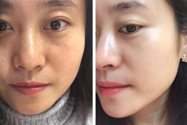 女人打美白针会变白吗,长期打美白针对身体有危害吗