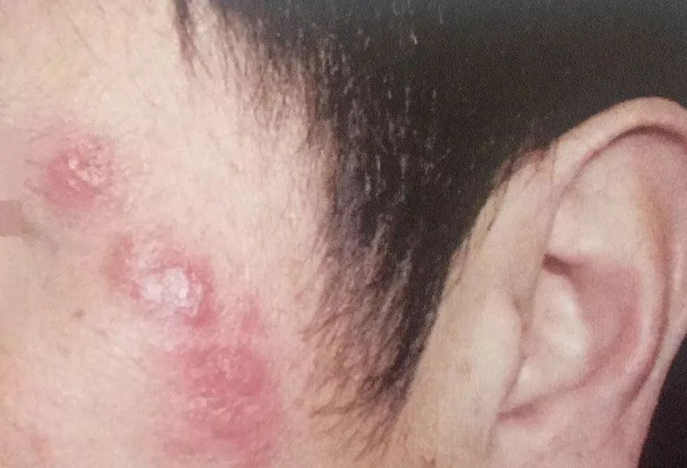 前胸后背长痘痘是毛囊炎吗,前胸后背很容易长痘痘中医治疗