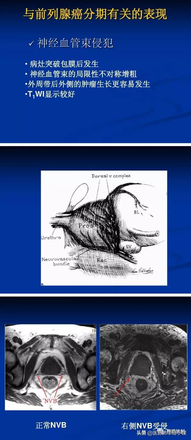 前列腺磁共振影像解剖,前列腺mri正常诊断报告模板