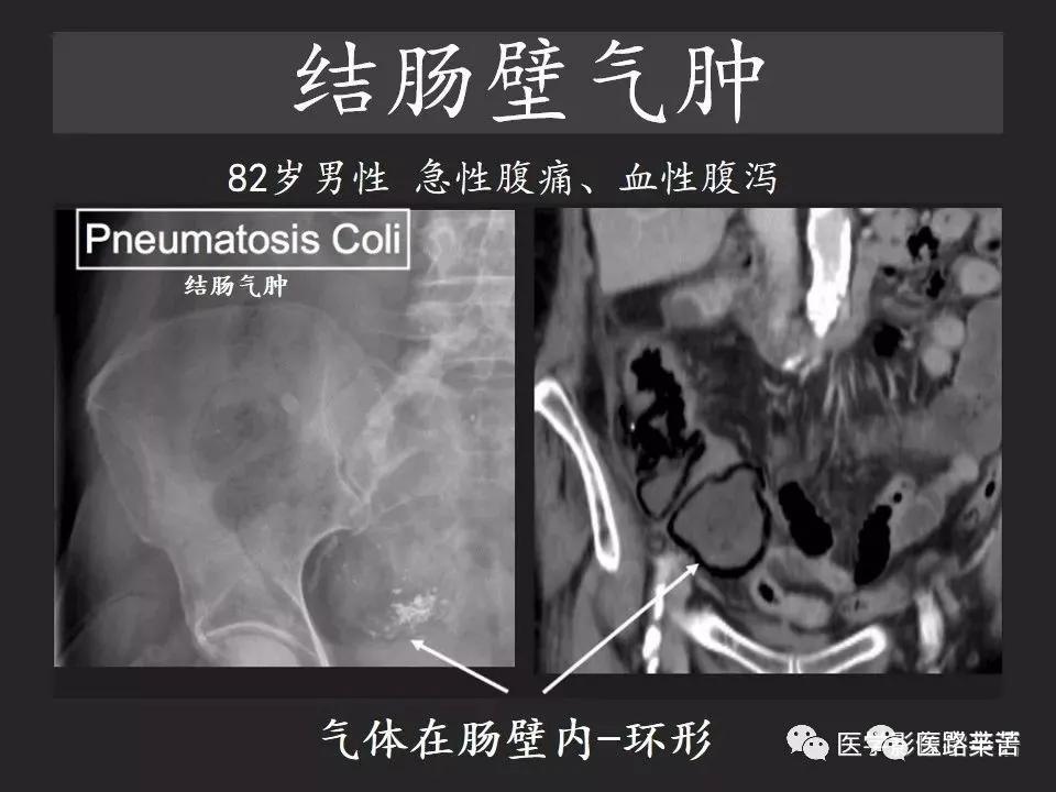 空腔脏器穿孔和胃肠道穿孔区别,腹膜后穿孔一般是哪里穿孔