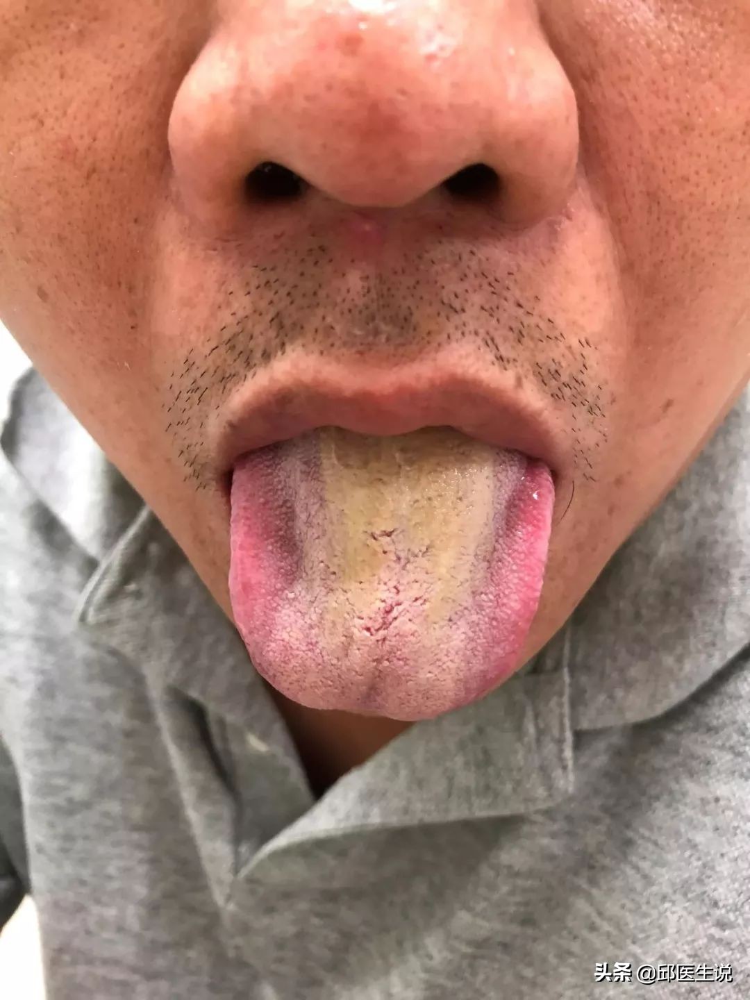 解决身体的湿气的偏方,身体湿气太重自己在家怎样除掉