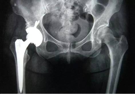 老年人骨折是什么骨折,老年人骨质疏松腰部骨折怎么办