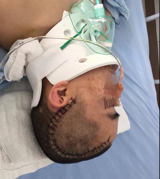 29岁男子车祸送医，神经外科“一站式”救治颅脑和脊柱脊髓复合伤