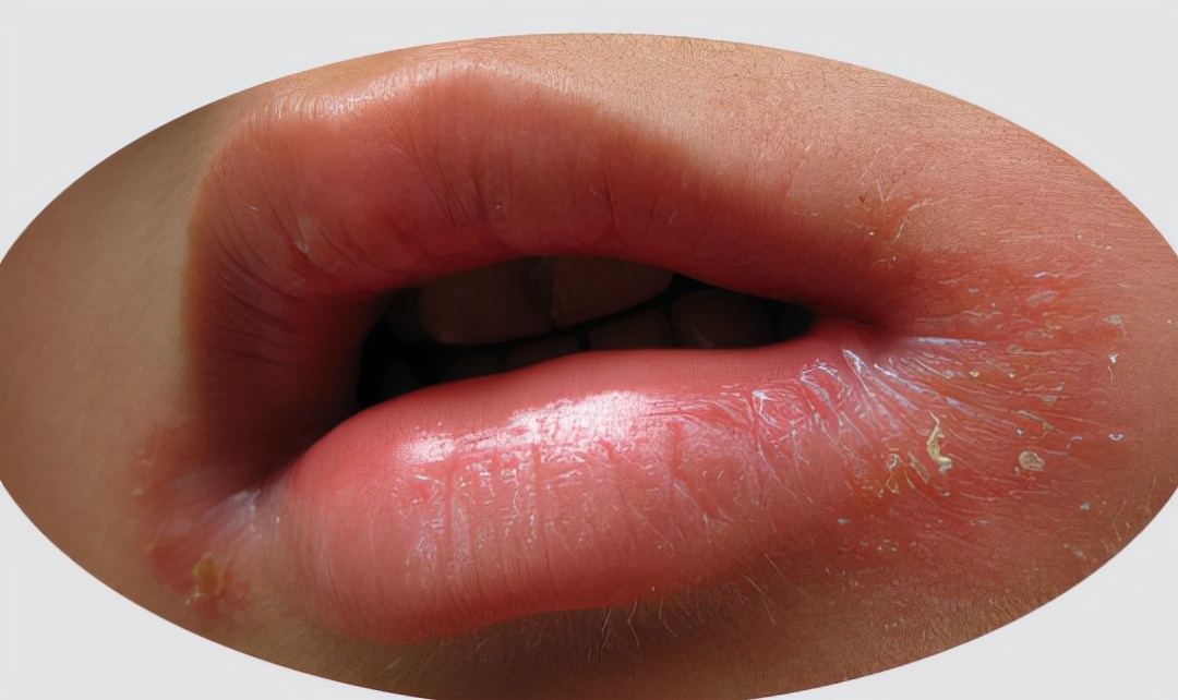 8成国人缺B2，经常上火就是它的锅。一文看懂如何补