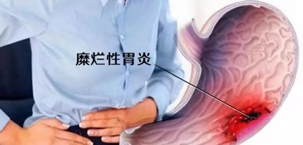 得了糜烂性胃炎需要注意什么,得了糜烂性胃炎吃什么药效果最好