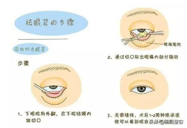 眼袋不仅难看,还特别显老,那么哪种去眼袋方法比较好呢?