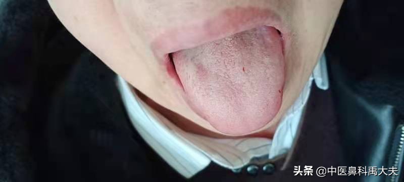 鼻炎怎么治教你一招改善鼻炎问题,过敏性鼻炎用哪一种洗鼻炎好