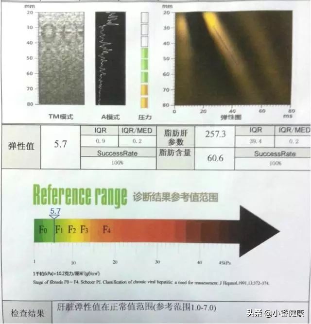 乙肝转氨酶升高66需要抗病毒吗,乙肝抗病毒四个月转氨酶反而升高