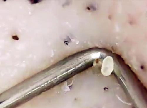 去黑头千万不能踩得雷，不但去不掉还让皮肤伤痕累累，你中了吗