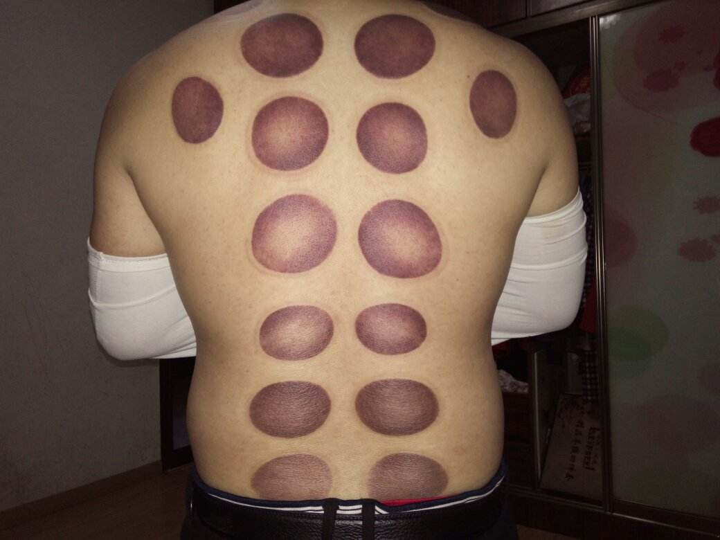 从西医角度分析拔火罐,中医的拔火罐有没有疗效