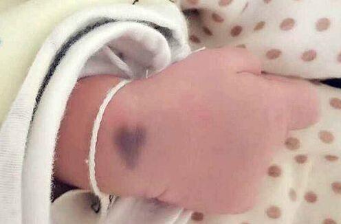 宝宝一出生就有雀斑样痣吗,出生的婴儿皮肤有黑斑怎么回事