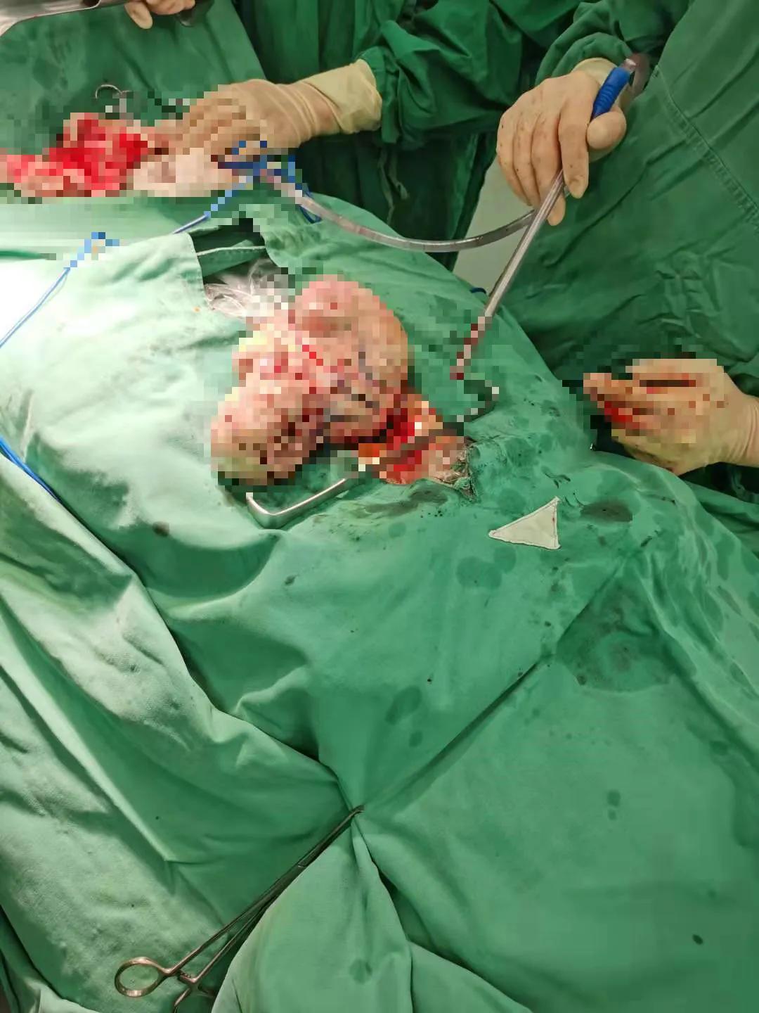 老人得了盆腔肿瘤能活多久,老人卵巢10厘米肿瘤