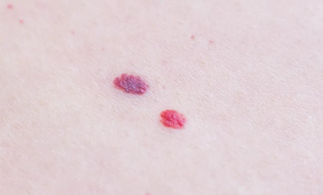 身上突然起小红点需要看医生吗,身上长了密密麻麻的小红点是什么