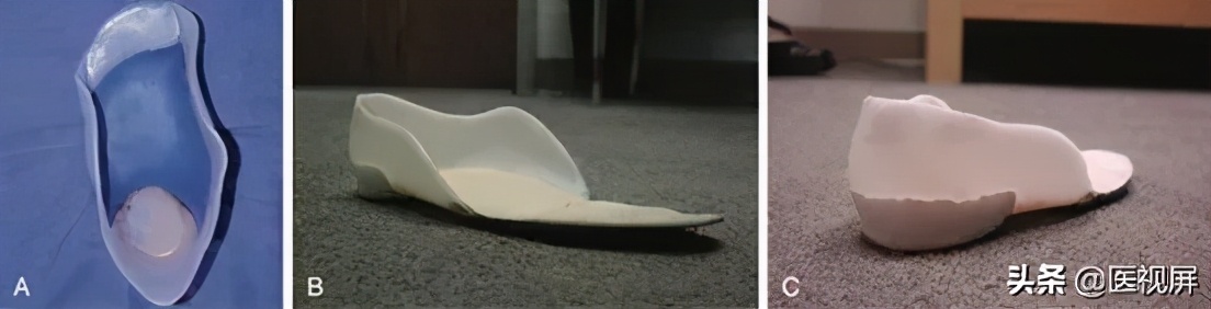 17岁平足症怎么治疗,青少年平足怎么办