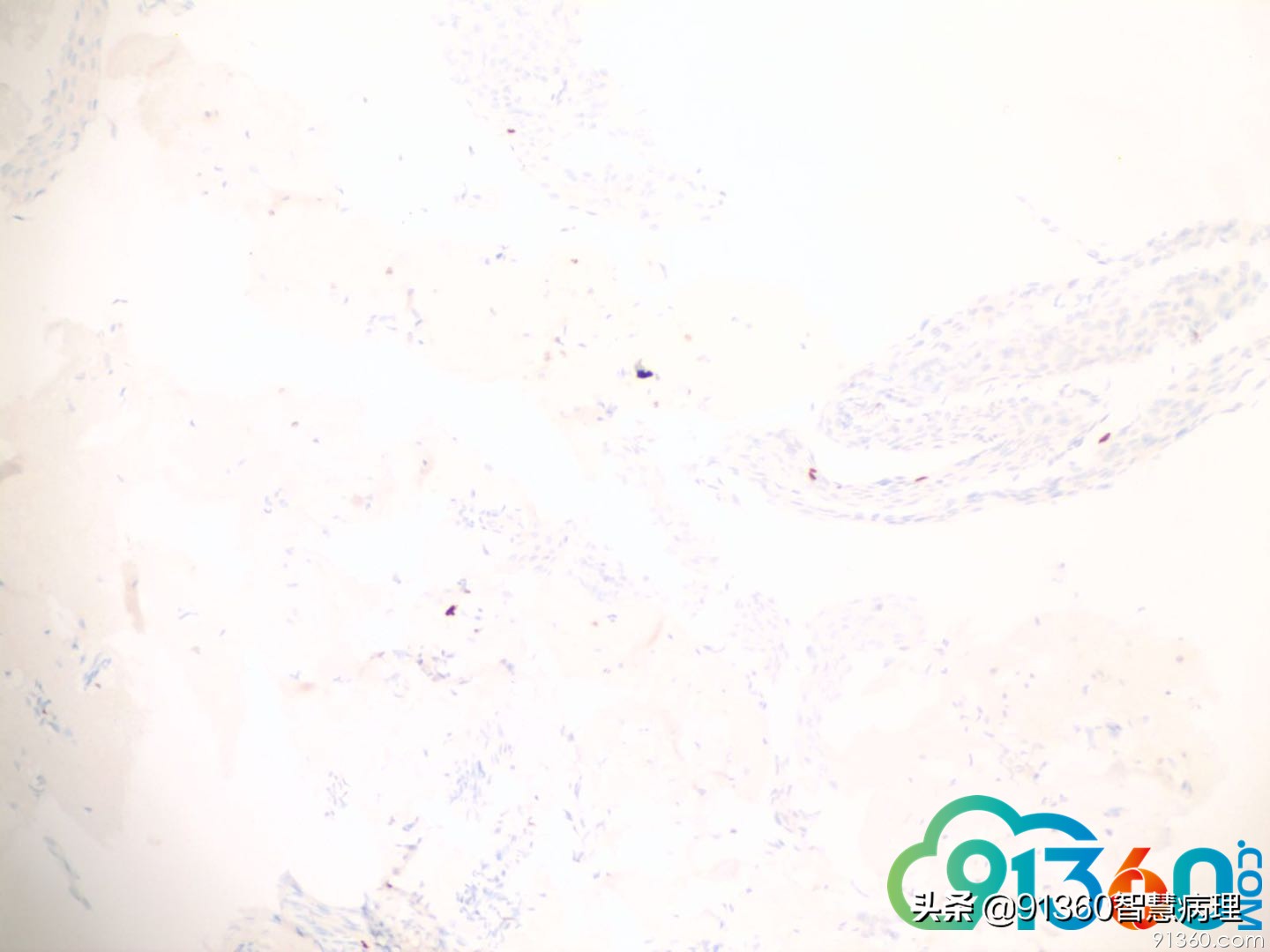 宫颈病理tct是什么检查,tct出现ascus会是宫颈癌吗