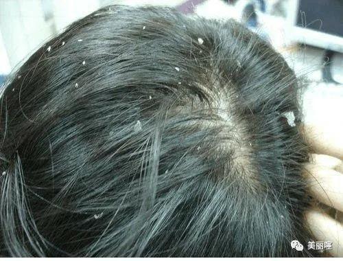 去头皮屑止痒洗发水排名黑榜,几款洗发水不合格