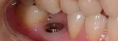 种植牙第一次拆线后的步骤,种植牙二期修复取模的步骤