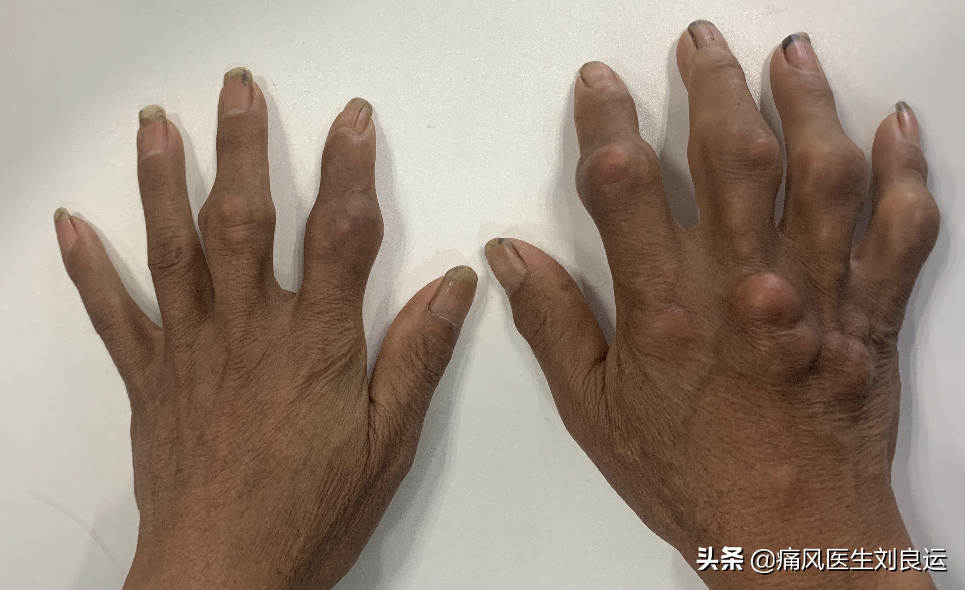 痛风是尿酸高的时候发作吗,痛风发作期间尿酸忽高忽低为什么