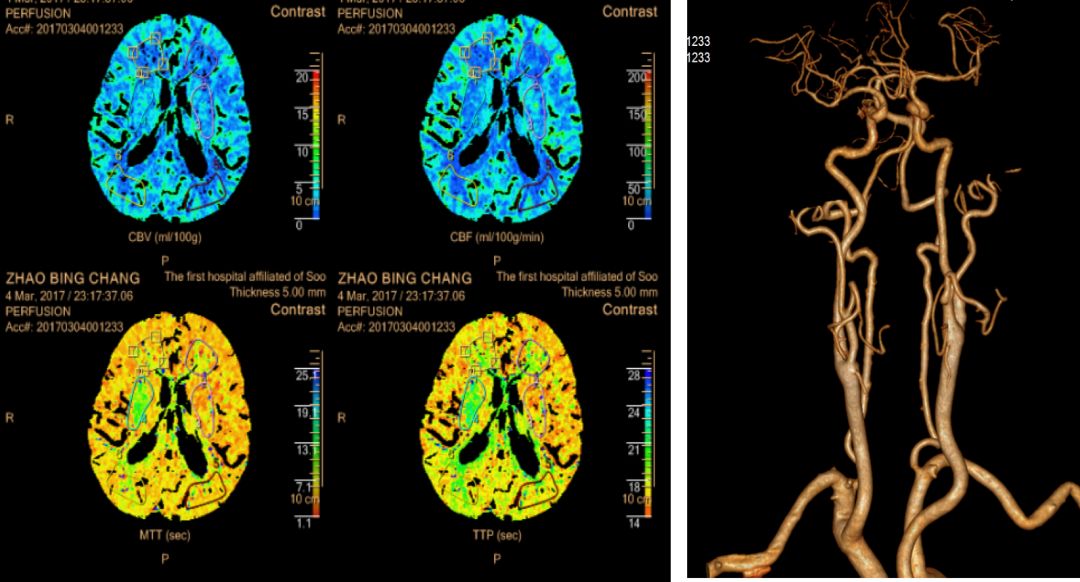 脑梗溶栓后脑出血脑疝晚期,阿替普酶溶栓后脑出血处理