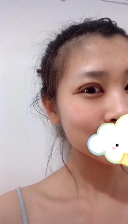 修志夫做双眼皮效果怎么样,修志夫双眼皮修复