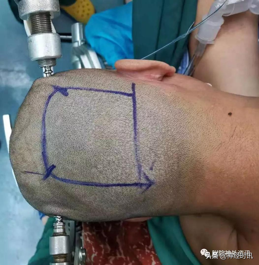 松果体占位怎样治疗,松果体区占位看什么科室