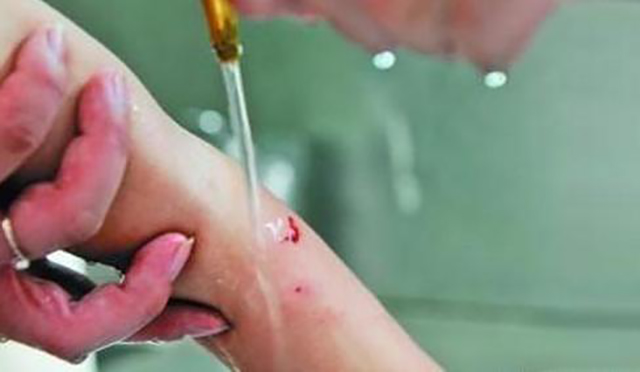 被自家狗狗伤需要打疫苗吗,被狗狗咬伤的位置红肿痛正常吗