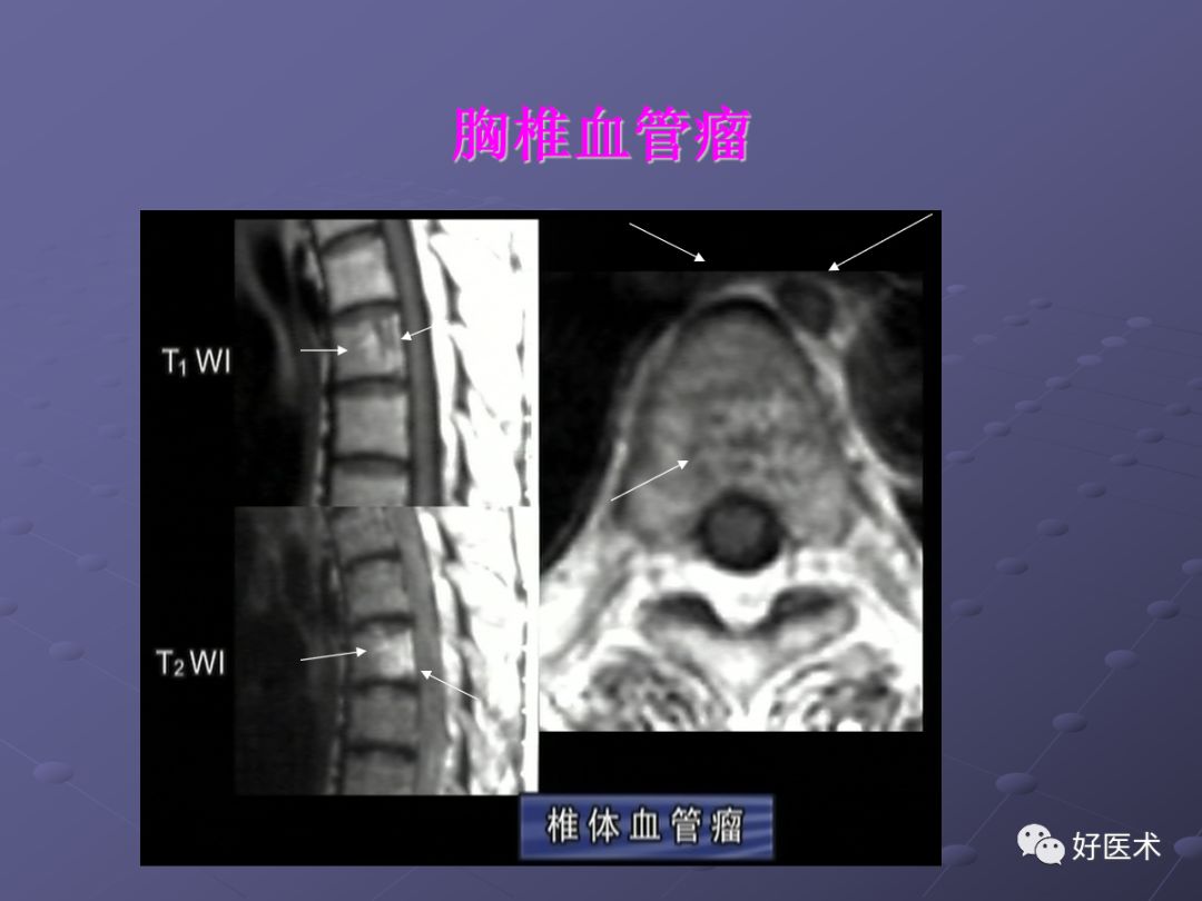 脊柱mri有哪些特点,乳腺疾病的mri诊断及鉴别