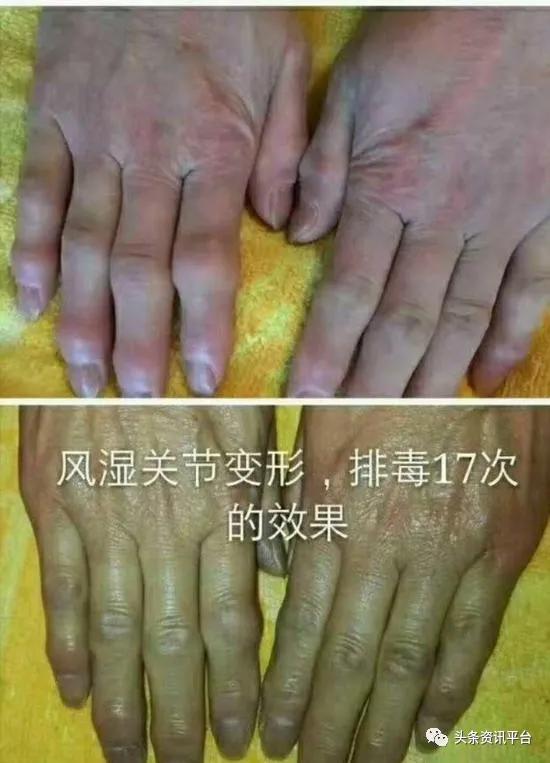 中氢平通仪真的能排毒吗,中科氢量平通仪真的有效果吗