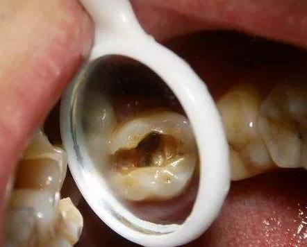 孩子牙痛要怎么解决,小朋友牙痛的原因有哪些呢